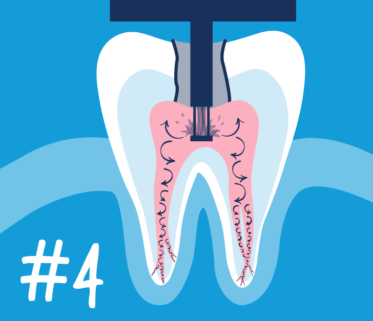 Root Canal Questions to Ask Your Endodontist GentleWave® Procedure